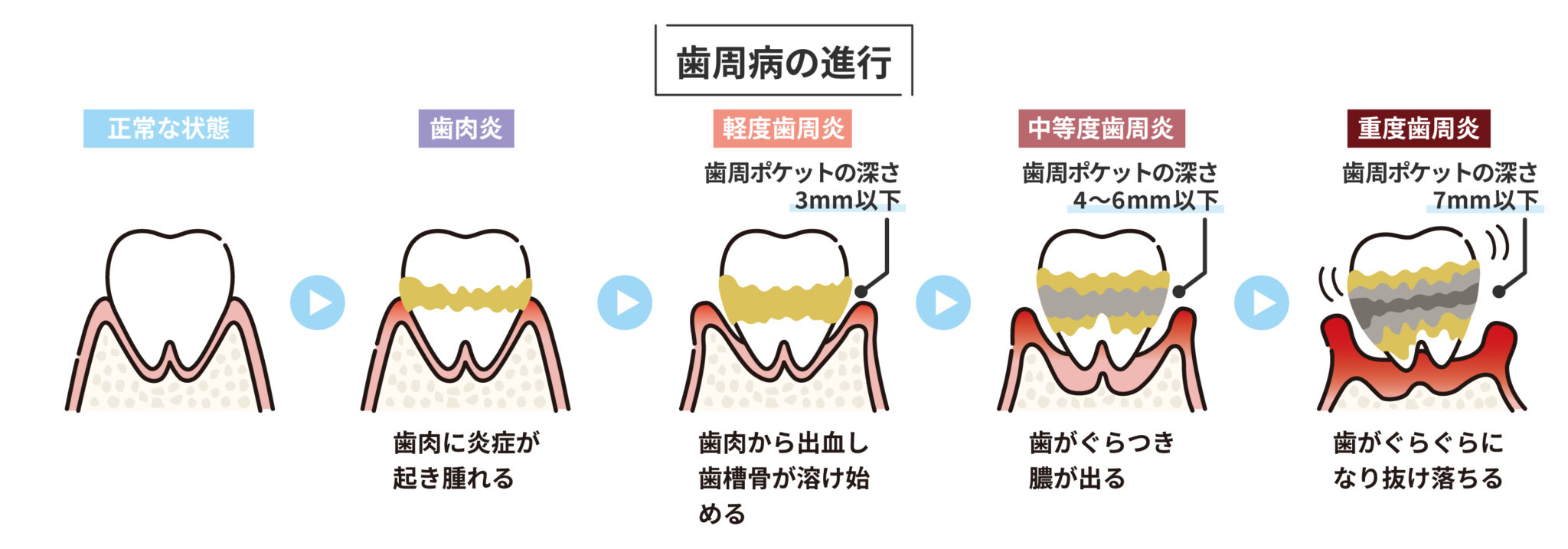 【無料】歯周病の進行のイラスト素材 | ピクシカ
